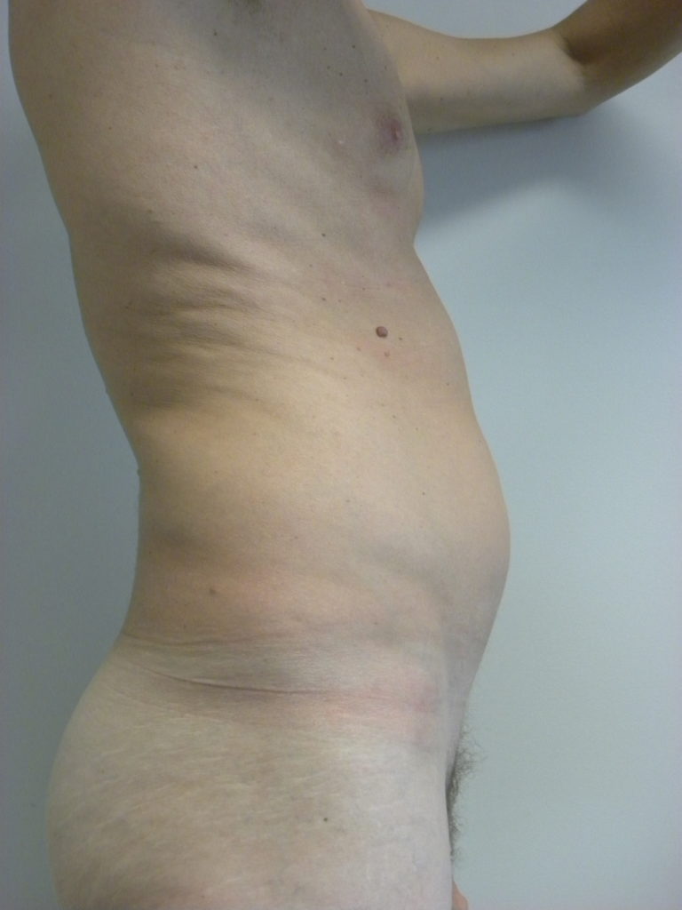 Liposuction before and after - before