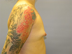 Breast Augmentation before and after - before