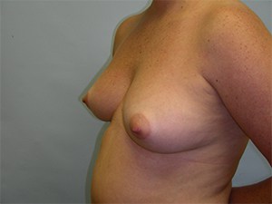 Breast Augmentation before and after - before