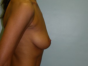 Breast Augmentation before and after - before