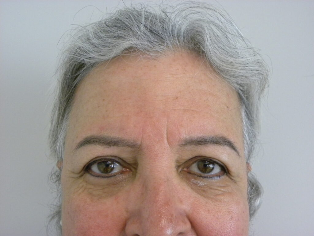 Blepharoplasty before and after - before
