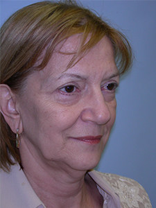 Facelift before and after - before