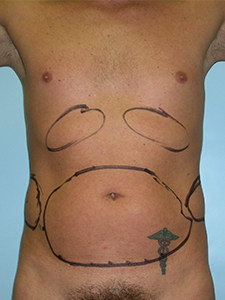 Liposuction before and after - before