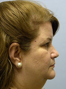 Facelift before and after - before