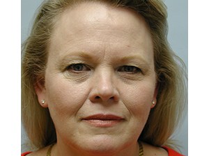 Blepharoplasty before and after - before