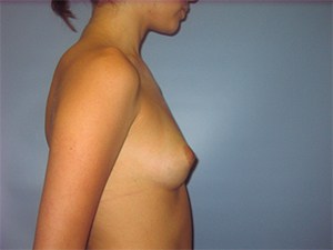 Breast Augmentation before and after - before