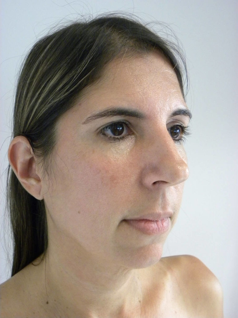 Chin before and after - before