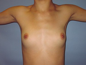 Breast Augmentation before and after - before