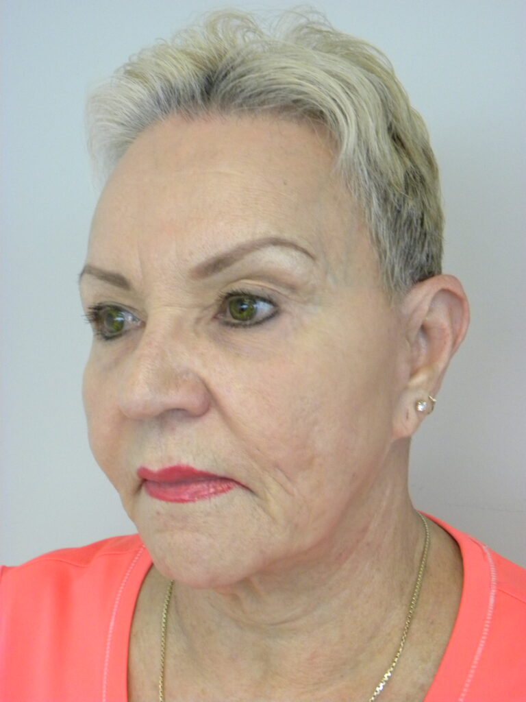 Facelift before and after - before