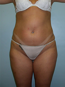 Liposuction before and after - before