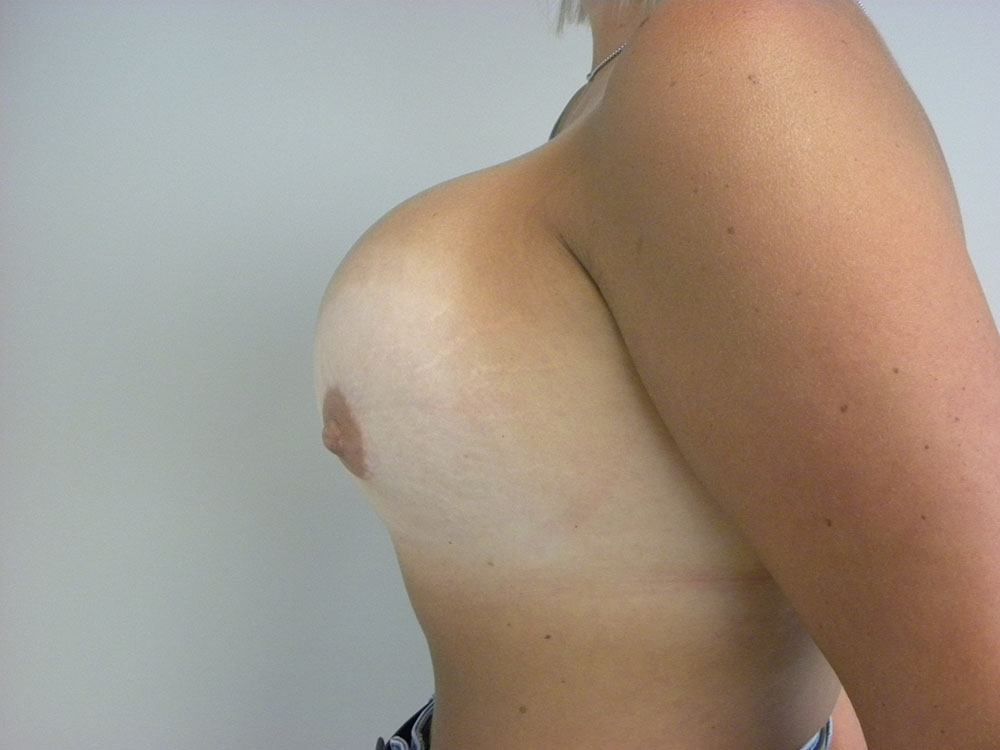 Breast Augmentation before and after - before