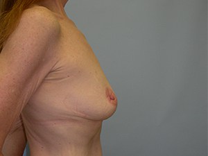 Breast Augmentation before and after - before