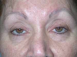 Blepharoplasty before and after - before