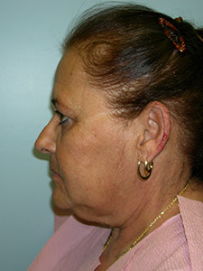 Facelift before and after - before