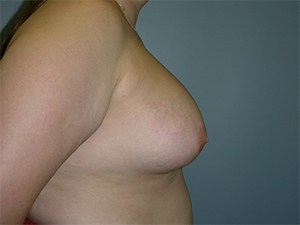 Breast Augmentation before and after - before