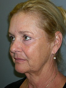 Facelift before and after - before