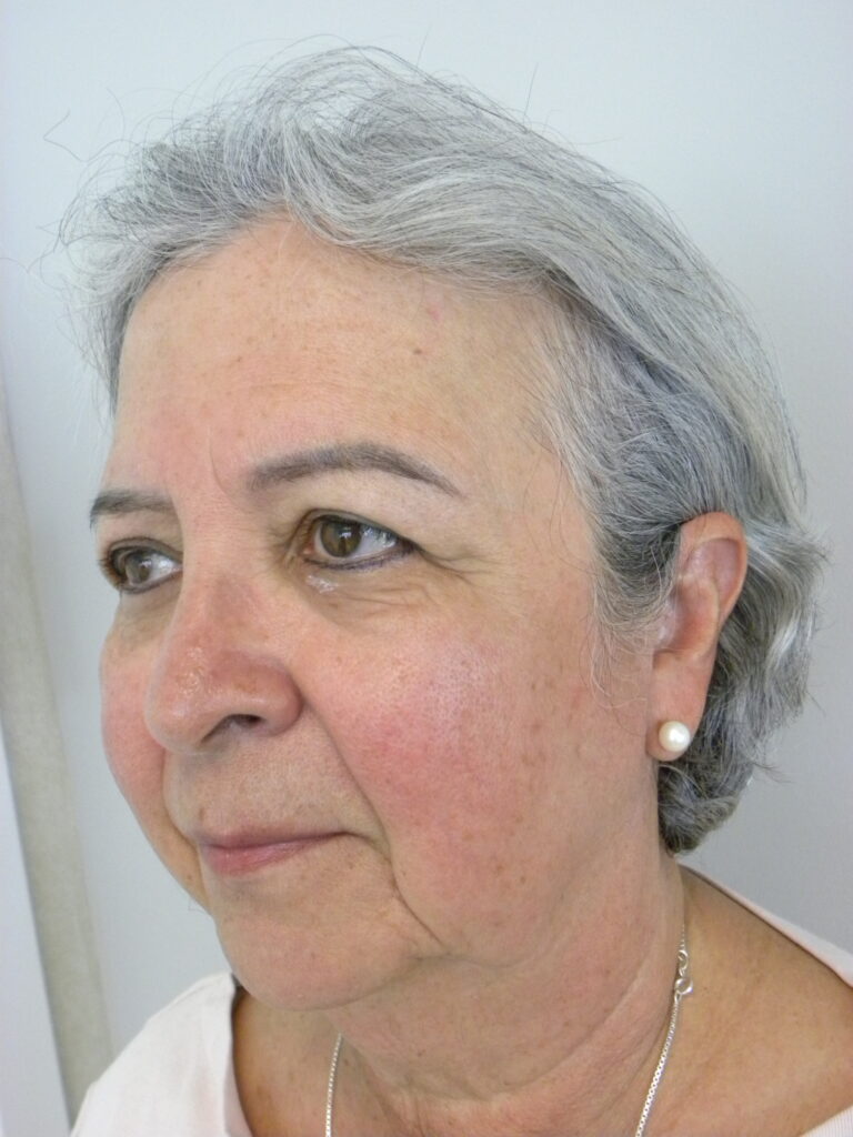 Blepharoplasty before and after - before