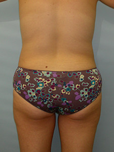 Liposuction before and after - before
