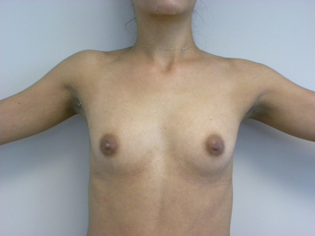 Breast Augmentation before and after - before