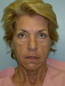 Facelift before and after - before