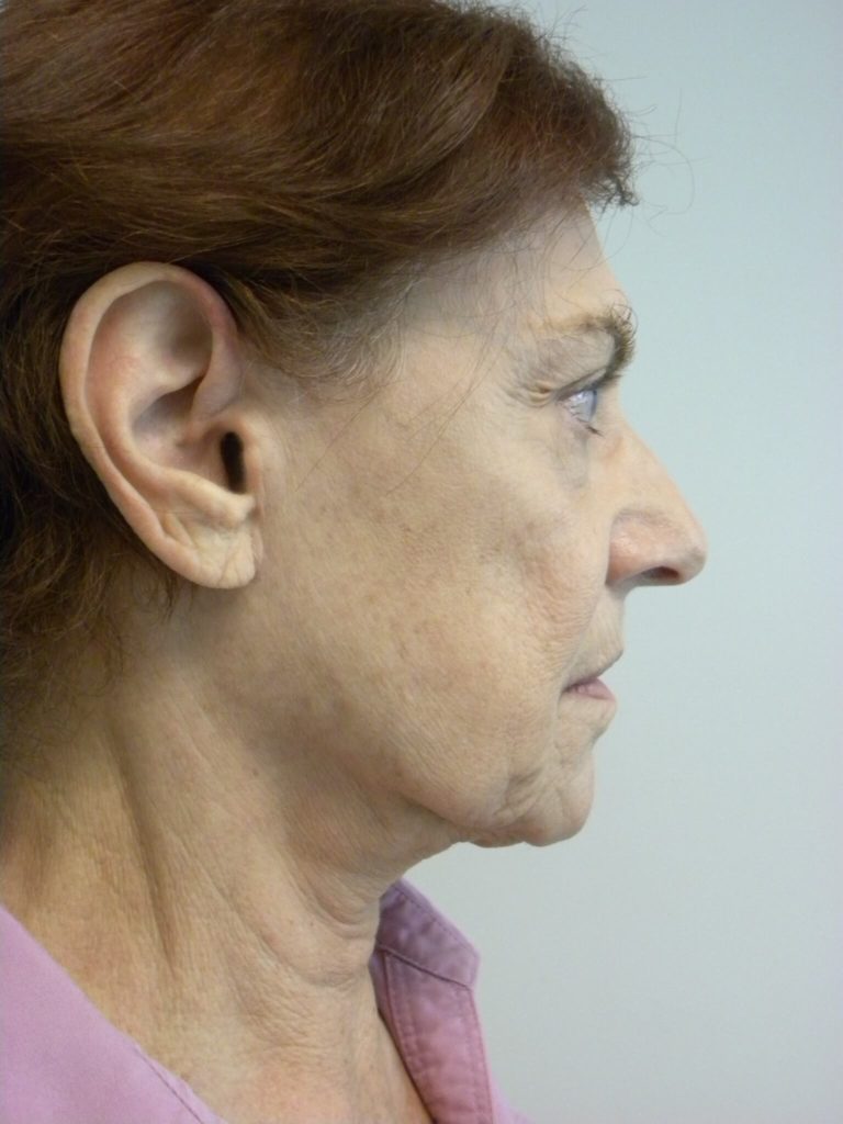 Facelift before and after - before