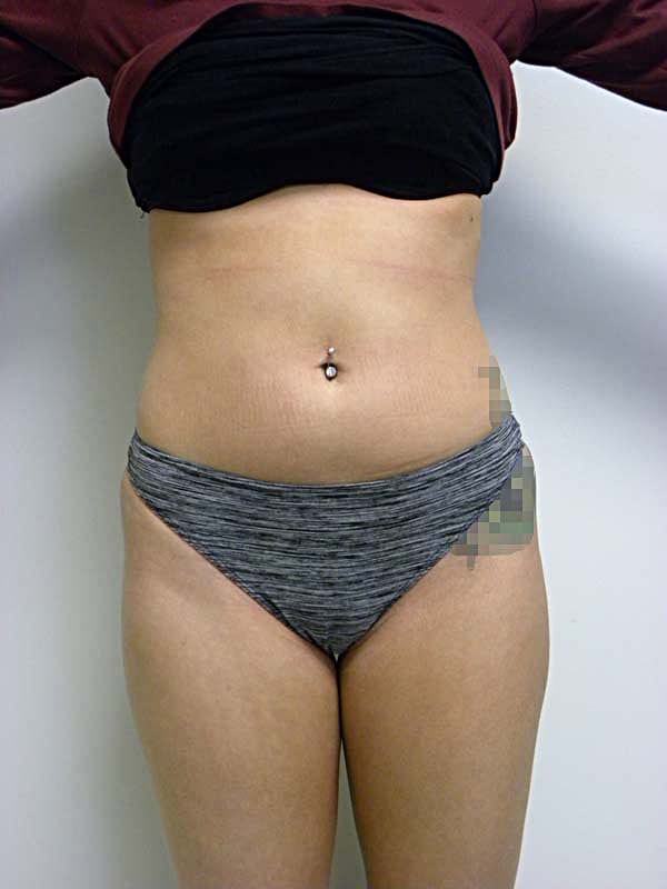 Liposuction before and after - before