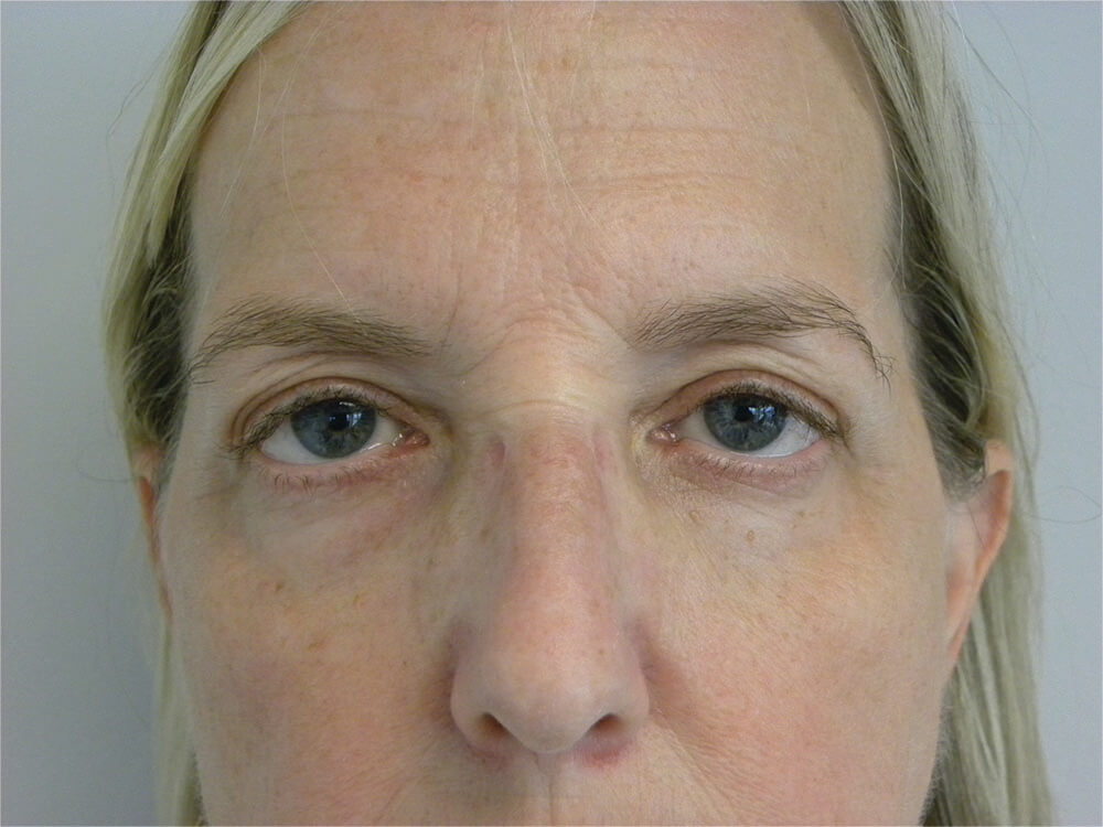 Blepharoplasty before and after - before