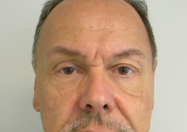 Blepharoplasty before and after - before