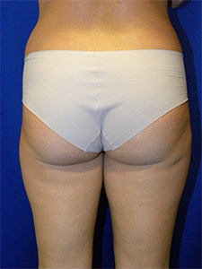 Liposuction before and after - before