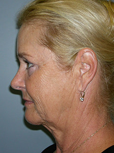Facelift before and after - before