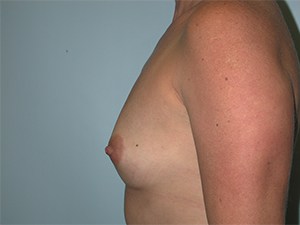 Breast Augmentation before and after - before