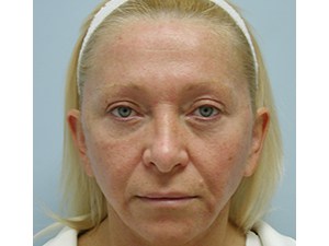 Facelift before and after - before