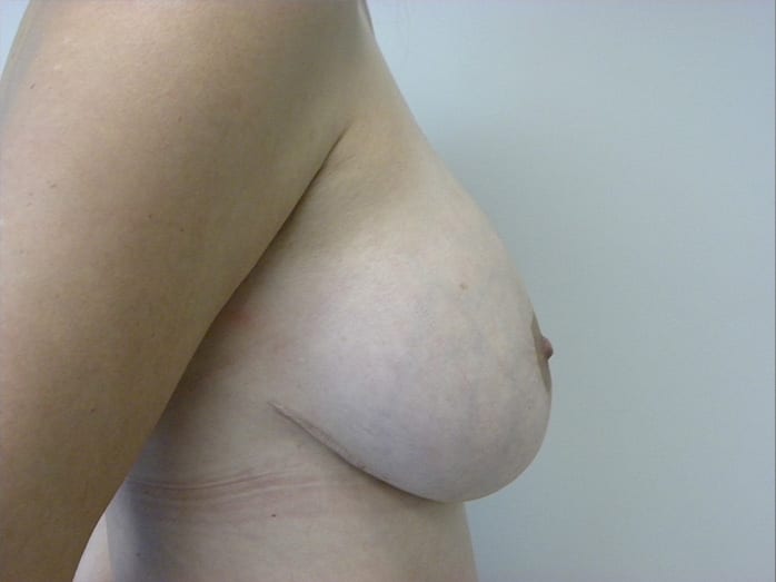 Breast Augmentation before and after - before
