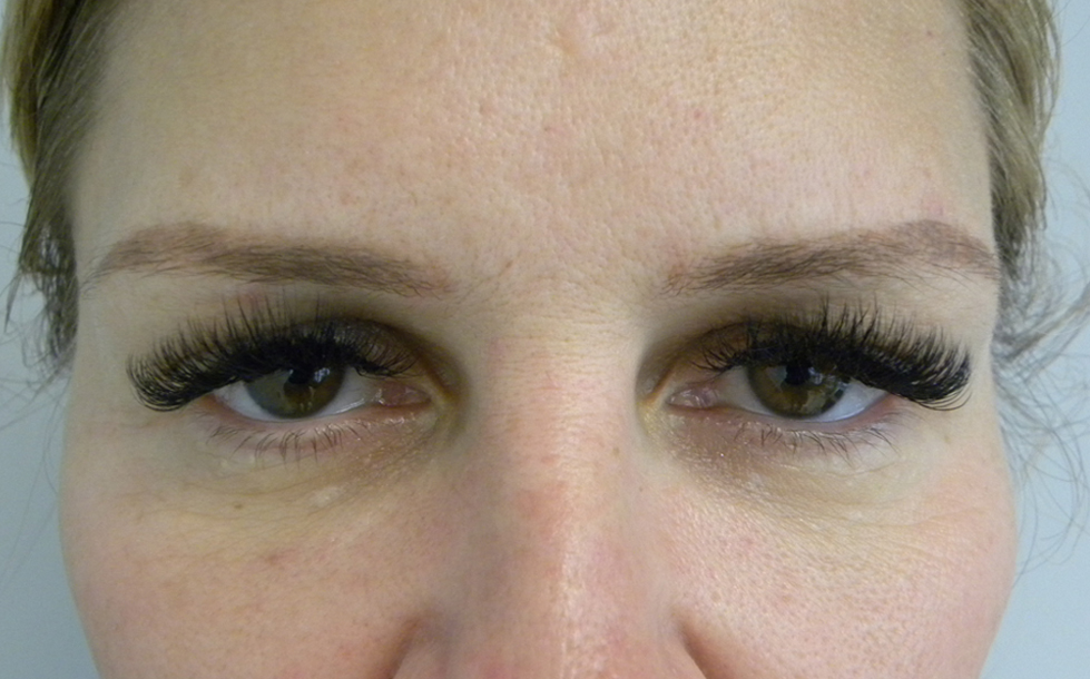 Blepharoplasty before and after - before