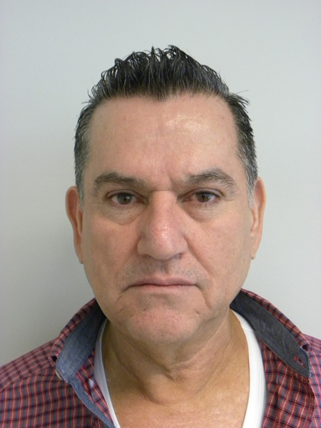 Facelift before and after - before