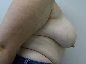 Breast Reduction before and after - before