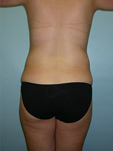 Liposuction before and after - before
