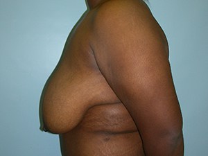 Breast Reduction before and after - before