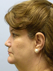Facelift before and after - before