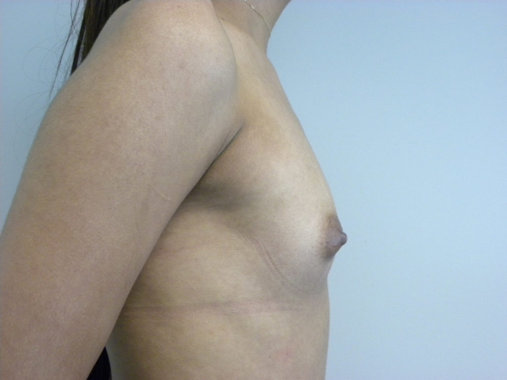 Breast Augmentation before and after - before