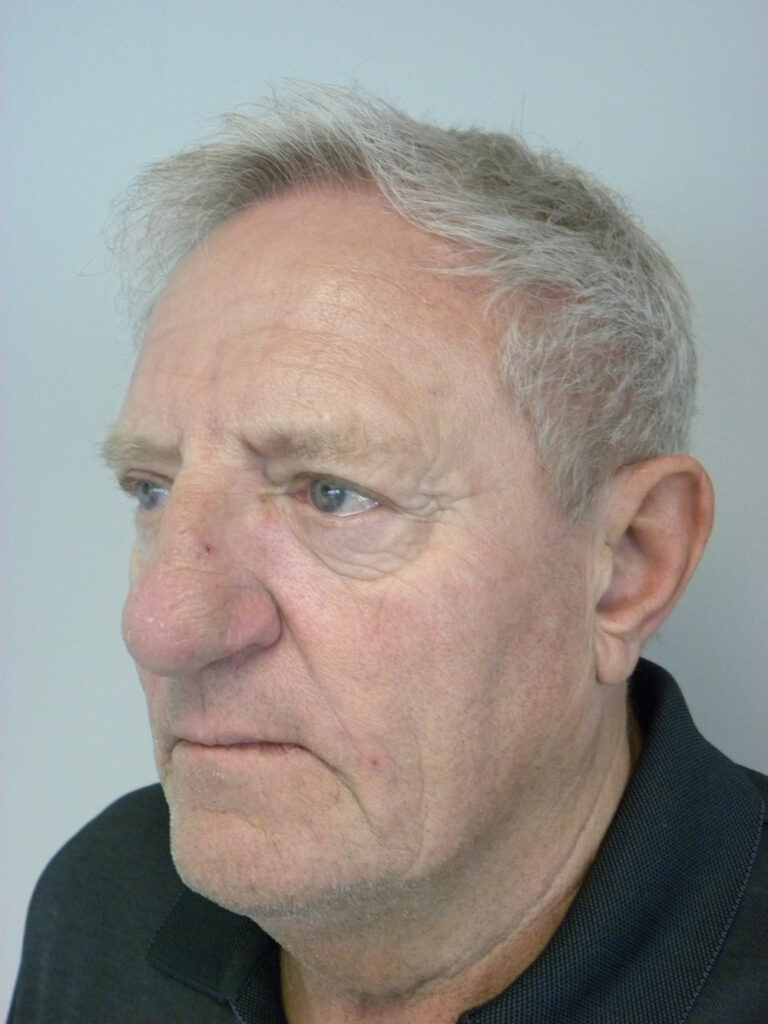 Facelift before and after - before