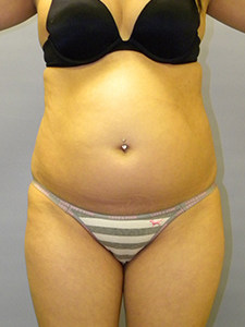 Liposuction before and after - before