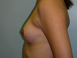 Breast Augmentation before and after - before
