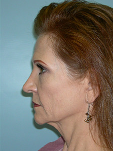 Facelift before and after - before