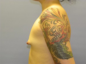 Breast Augmentation before and after - before