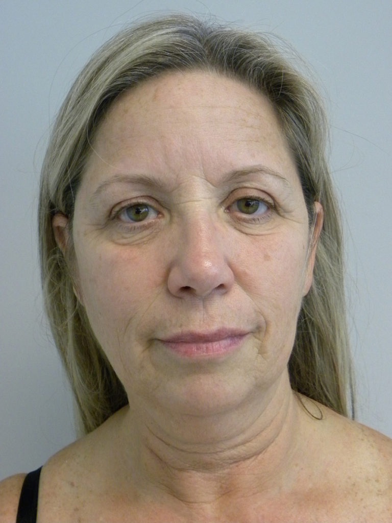 Facelift before and after - before