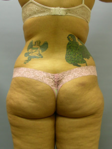 Liposuction before and after - before