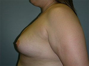 Breast Augmentation before and after - before
