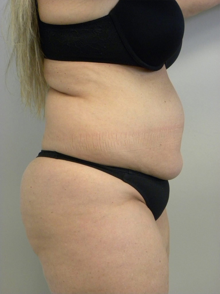 Liposuction before and after - before