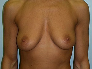 Breast Augmentation before and after - before